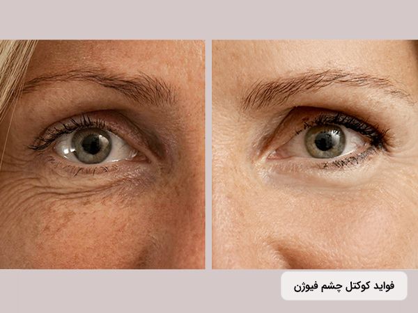 کوکتل دور چشم فیوژن (fusion eye contour)